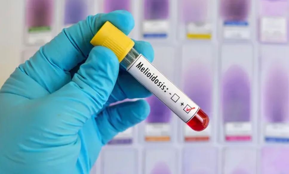 बीकानेर में मेलियोइडोसिस पर विशेष सीएमई: ICMR की पहल से बढ़ेगी चिकित्सा समझ
