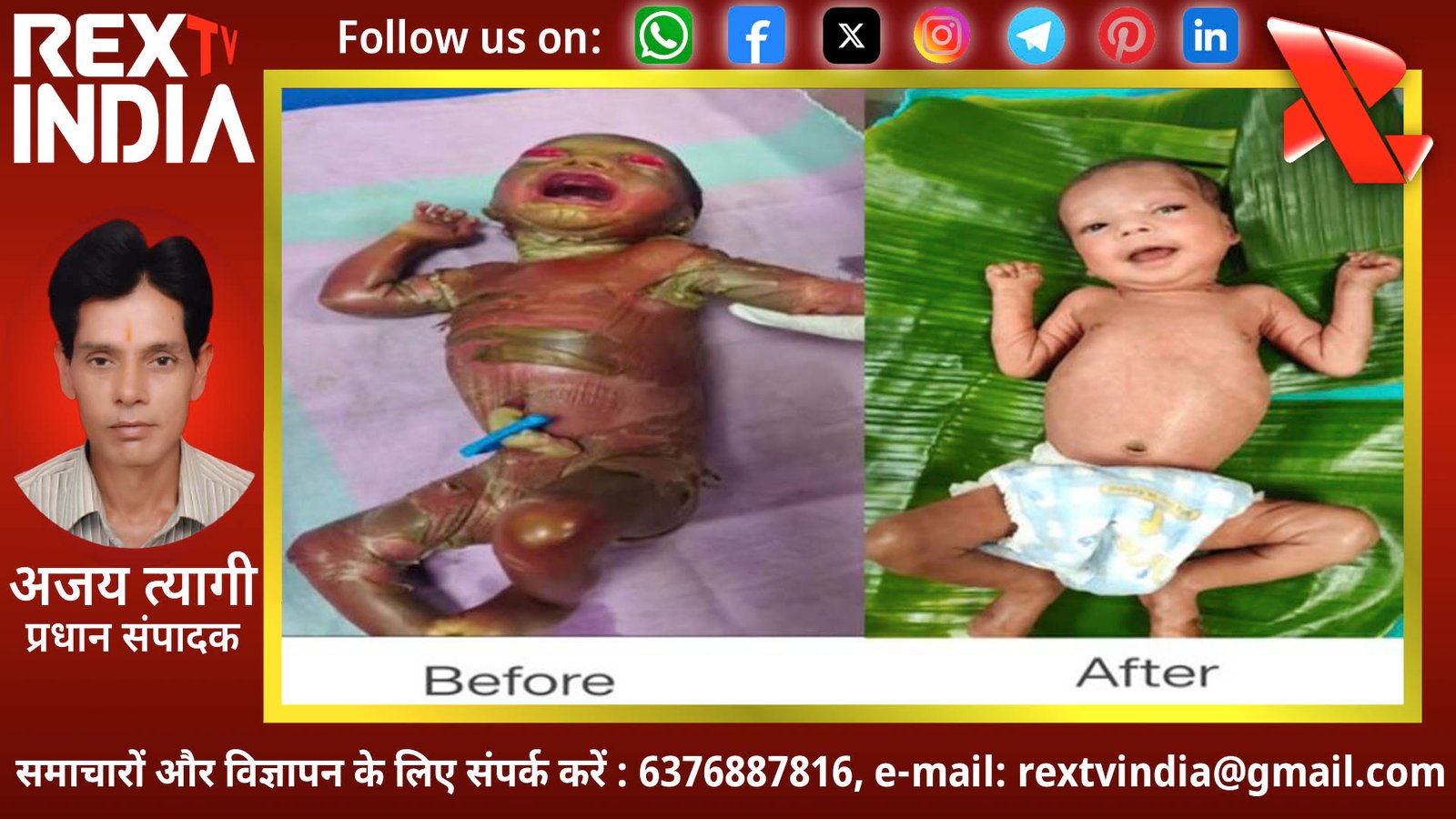 बीजापुर के डॉक्टरों ने रचा इतिहास: दुर्लभ स्केल्डेड स्किन बीमारी से नवजात को दी नई जिंदगी