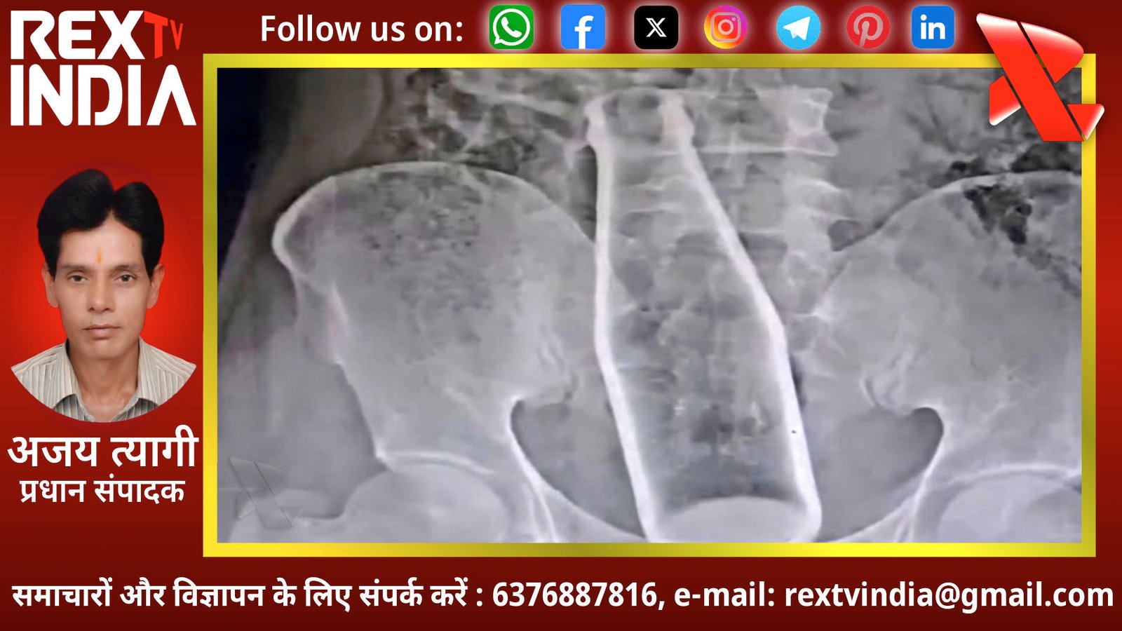 झारखण्ड में मेडिकल मिस्ट्री: मलद्वार के रास्ते युवक के पेट तक पहुँची बोतल, पुलिस जांच में उलझा मामला