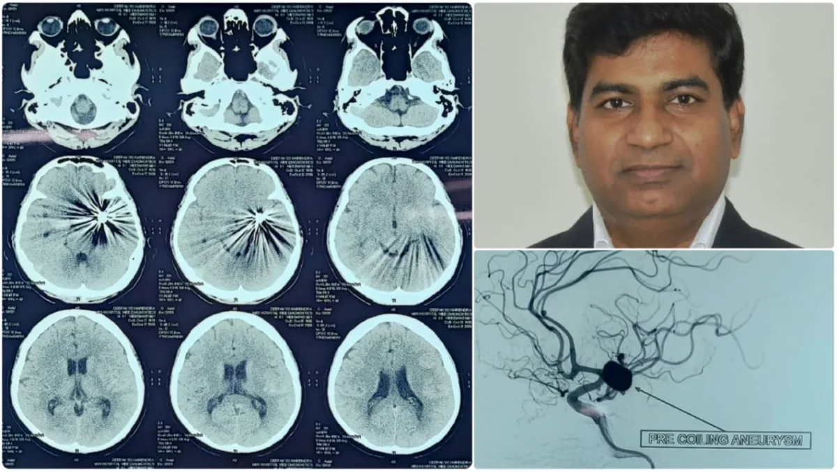 ब्रेन एन्यूरिज्म उपचार में सफलता, विशेषज्ञों ने अपनाई कोइलिंग तकनीक