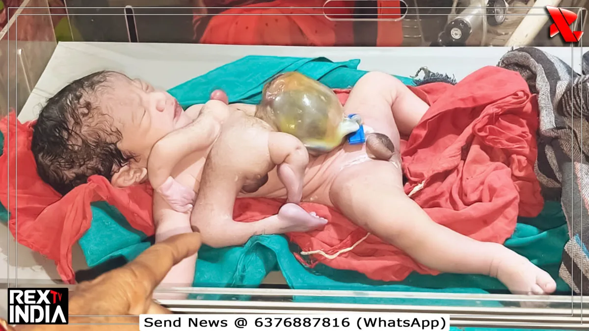 चार हाथ चार पैर वाला नवजात, डॉक्टरों ने बेहतर इलाज के लिए भेजा